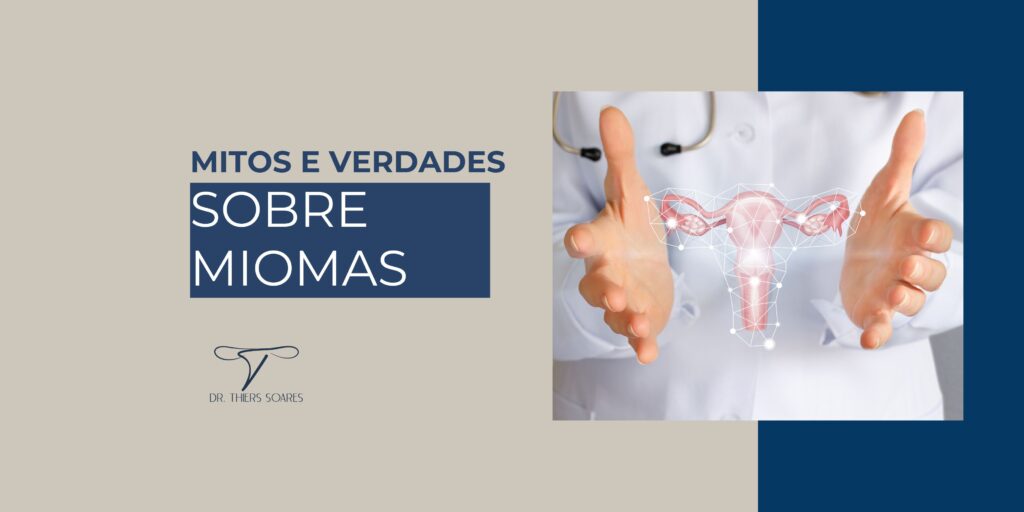 Os miomas, que também são conhecidos como fibroma ou leiomioma uterino, são tumores, em sua maioria benignos, que acontecem no tecido muscular do útero. Eles estão presentes em cerca de 80% das mulheres, com tamanhos e em locais diferentes. Embora o número significativamente grande de pacientes com esta doença, somente em poucos casos é necessário realizar uma cirurgia.  Apesar de ser tão comum, os Miomas ainda são cercados de dúvidas. É fundamental que as  mulheres tenham informações básicas desta doença para se cuidarem, questionarem e se tratarem. Esse conhecimento é muito importante para todas as mulheres, especialmente para aquelas que desejam engravidar.  Entenda mais sobre os mitos e as verdades sobre o Mioma: