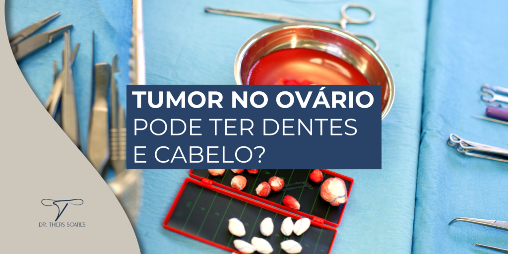 Existem dois tipos de Teratoma, os imaturos que são mais propensos a serem cancerígenos e os Teratomas maduros que tendem a serem benignos. Os maduros são mais encontrados nos ovários, em grande maioria nas mulheres que estão na fase anterior à menopausa. Quanto mais tempo os Teratomas ficam dentro do organismo, maiores são as chances dele se tornar cancerígeno.