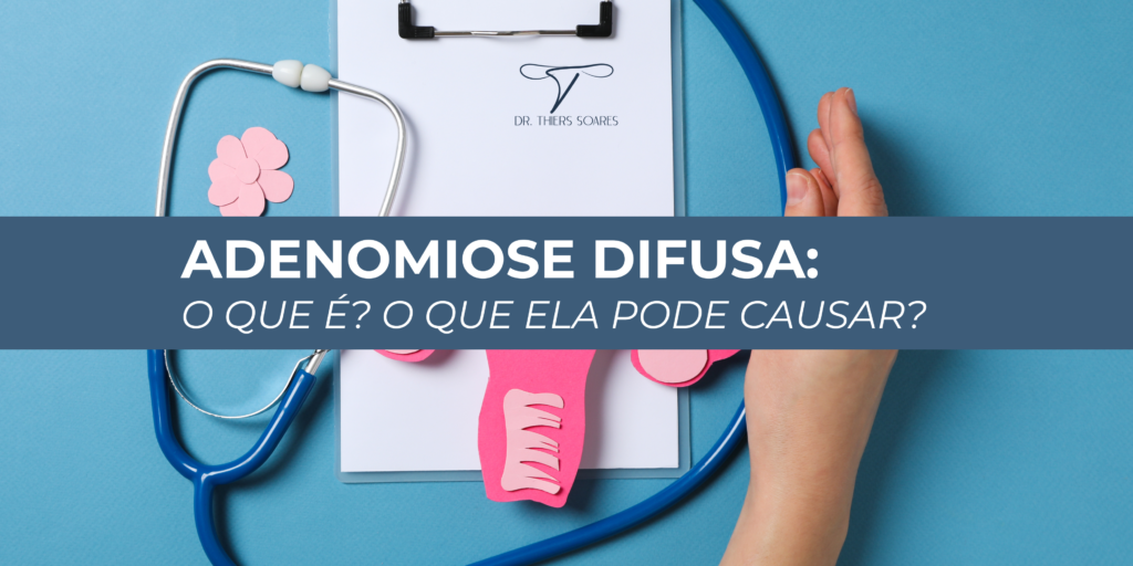 Quando falamos da adenomiose, em geral, sabemos que ela acontece no momento em que o endométrio, a camada que reveste a parte interna do útero, se infiltra no miométrio, que é o nome do músculo do útero, que o endométrio reveste internamente . A adenomiose difusa é uma situação mais grave, pois ao invés de estar focado em um lugar, ele se espalha e está presente em todas as paredes do útero. É possível que a mulher que possui essa doença possa conviver com ela por anos e não desconfiar que a possui, já que em alguns casos ela pode ser assintomática. Mas existem alguns fatores que podem desencadear sintomas como, por exemplo:
