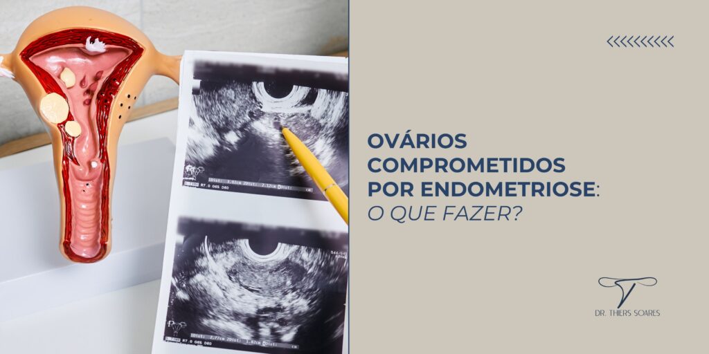 O sonho de ter uma gestação pode ficar abalado quando a mulher recebe esse diagnóstico, pois um dos sintomas mais graves é a dificuldade para engravidar, ainda mais se outros órgãos também estiverem comprometidos.