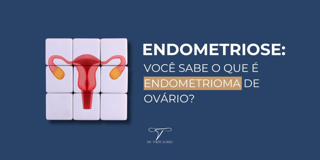 É importante destacar que o tratamento do endometrioma deve ser individualizado e levar em consideração as necessidades e preferências da paciente, além da orientação médica especializada. Busque acompanhamento de um médico especialista em endometriose para avaliar o melhor curso de ação e garantir um tratamento adequado e personalizado.