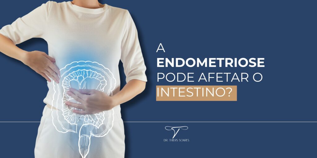 Os sintomas gastrointestinais relacionados à endometriose, como dor abdominal, cólicas, alterações intestinais e desconforto durante a defecação, podem causar uma série de desafios físicos, emocionais e sociais. Existem algumas questões importantes a serem consideradas ao discutir o impacto da endometriose intestinal na qualidade de vida.