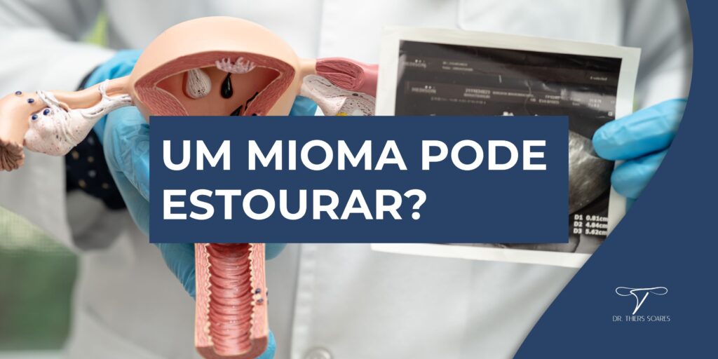 Embora os miomas possam passar por alterações, como degeneração ou torção, esses processos não resultam em um “estouro” do mioma. Em alguns casos, um mioma pode ter uma degeneração, alterar sua consistência para uma textura mais macia ou pode sofrer uma torção se o mioma estiver pediculado, ou seja, conectado ao útero por um pedículo estreito. Outra ocorrência relacionada é o infarto do mioma, que pode causar dor aguda, no entanto, esse evento é muito incomum.
