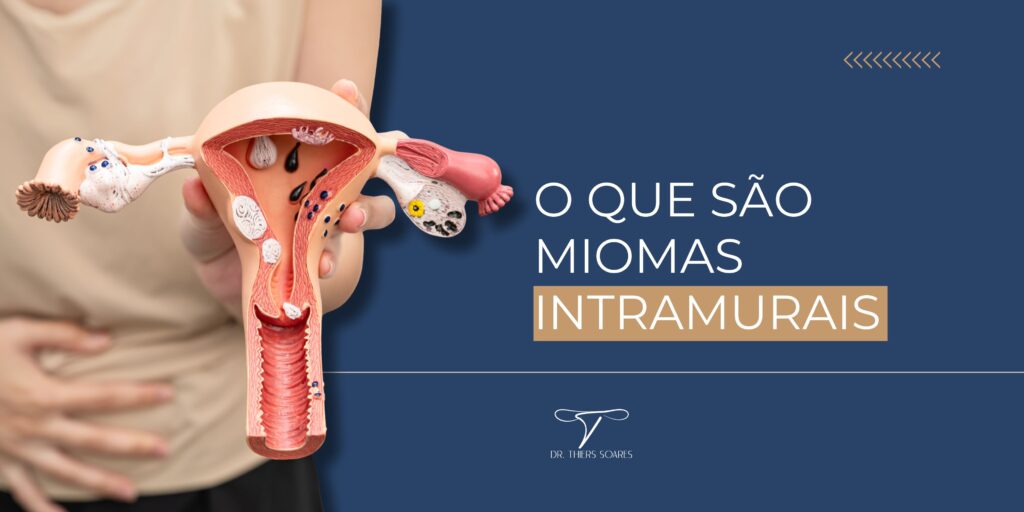 Os miomas intramurais são uma das formas mais comuns de miomas uterinos e podem causar sintomas como dor pélvica, menstruação intensa e dificuldade para engravidar. No entanto, com o diagnóstico precoce e o acompanhamento de um ginecologista especializado em miomas, é possível tratar a condição sem precisar retirar o útero. O Dr. Thiers Soares é referência em cirurgias minimamente invasivas e preservação uterina, oferecendo tratamentos personalizados que respeitam o desejo de cada mulher de manter a fertilidade e preservar o útero.