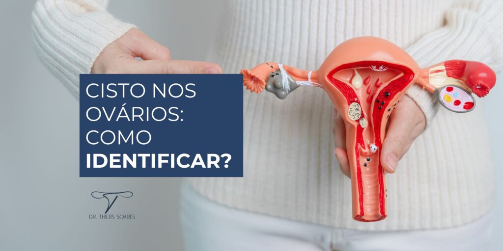 Um cisto no ovário se forma quando pequenas bolsas com líquido ou material semissólido se desenvolvem nos ovários. Isso ocorre quando há interrupções no processo de ovulação, quando um óvulo é liberado do ovário. Se esse ciclo é desordenado, o folículo que deveria liberar o óvulo pode crescer e se tornar um cisto.