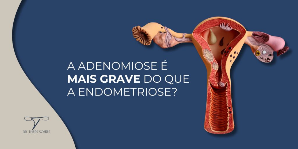 A adenomiose ocorre quando o tecido que reveste o interior do útero (endométrio) cresce na parede muscular do útero. Isso pode causar dor pélvica crônica, menstruações prolongadas e dolorosas, e em alguns casos, complicações como infertilidade ou aborto espontâneo.