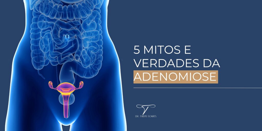 Em uma matéria realizada pelo portal Terra, Dr. Thiers Soares compartilhou informações sobre a adenomiose e esclareceu algumas crenças sobre essa condição que afeta as paredes musculares do útero. Veja abaixo, os 5 mitos e verdades abordados pelo Dr. Thiers: