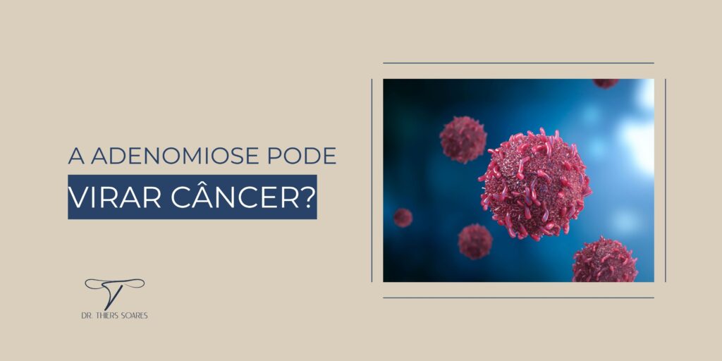 Há um mito comum de que a adenomiose pode evoluir para câncer, mas essa ideia não corresponde aos fatos. No entanto, é importante ficar de olho em fatores que podem influenciar a saúde uterina e agravar sintomas. A adenomiose ocorre quando o tecido que reveste o útero internamente, chamado endométrio, se infiltra na musculatura uterina. Isso pode causar aumento do útero, fluxo menstrual intenso, dores pélvicas constantes e desconfortos ao longo do ciclo. As causas ainda não são totalmente claras, mas suspeita-se que alterações hormonais e inflamações tenham influência no surgimento da condição.