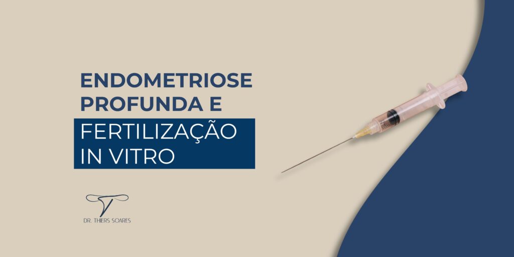 História real de superação da endometriose profunda: cirurgia e FIV resultam em gravidez bem-sucedida. Entenda como o tratamento integrado faz diferença.